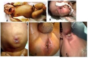 Read more about the article Leucocyte adhesion deficiency